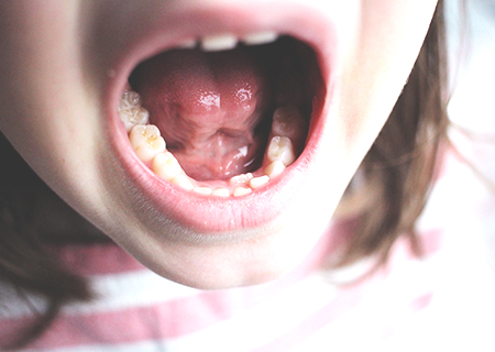 子どもの虫歯リスク検査