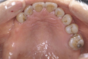 治療用入れ歯の作成+前処置